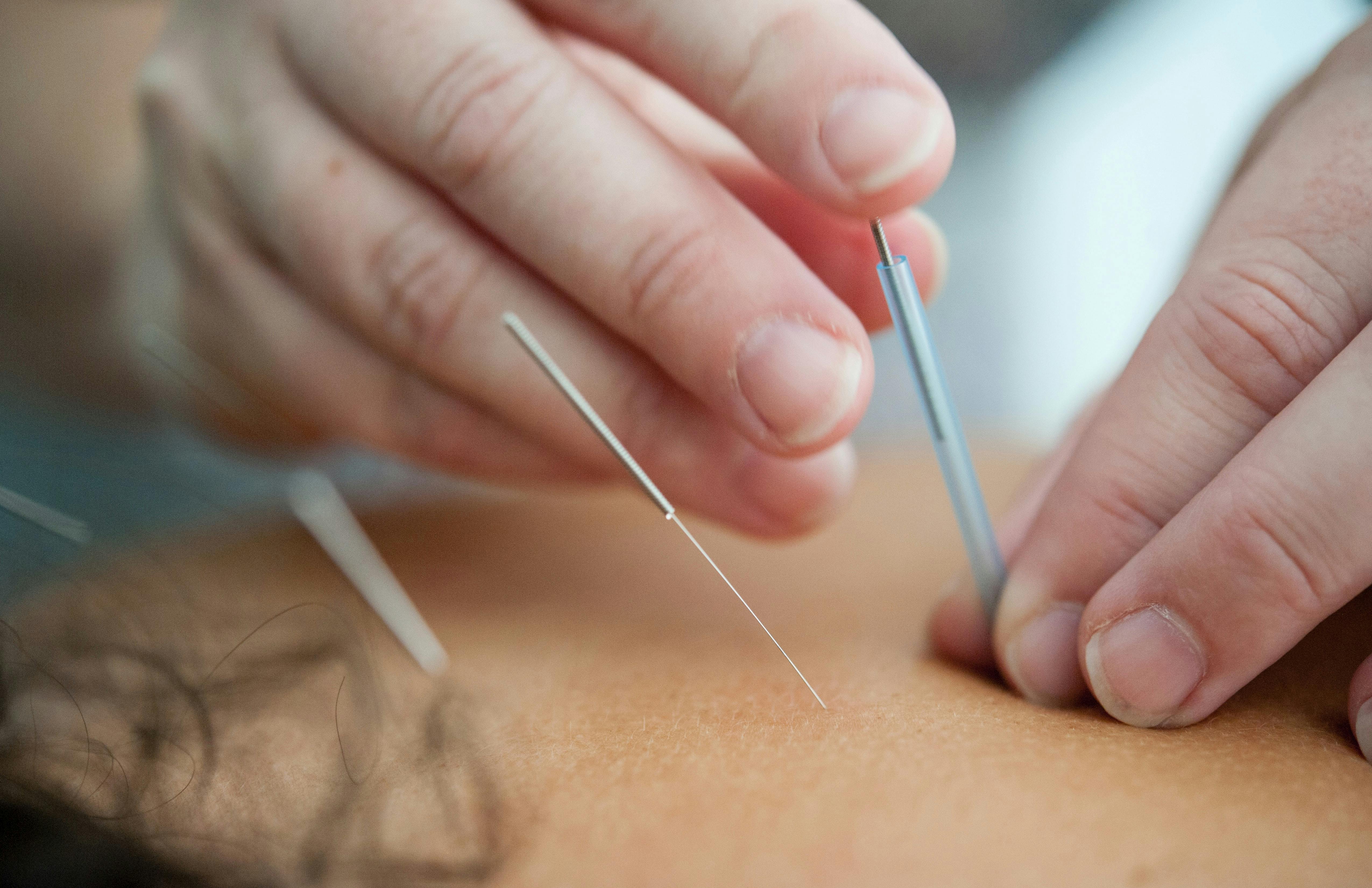 gravid akupunktur