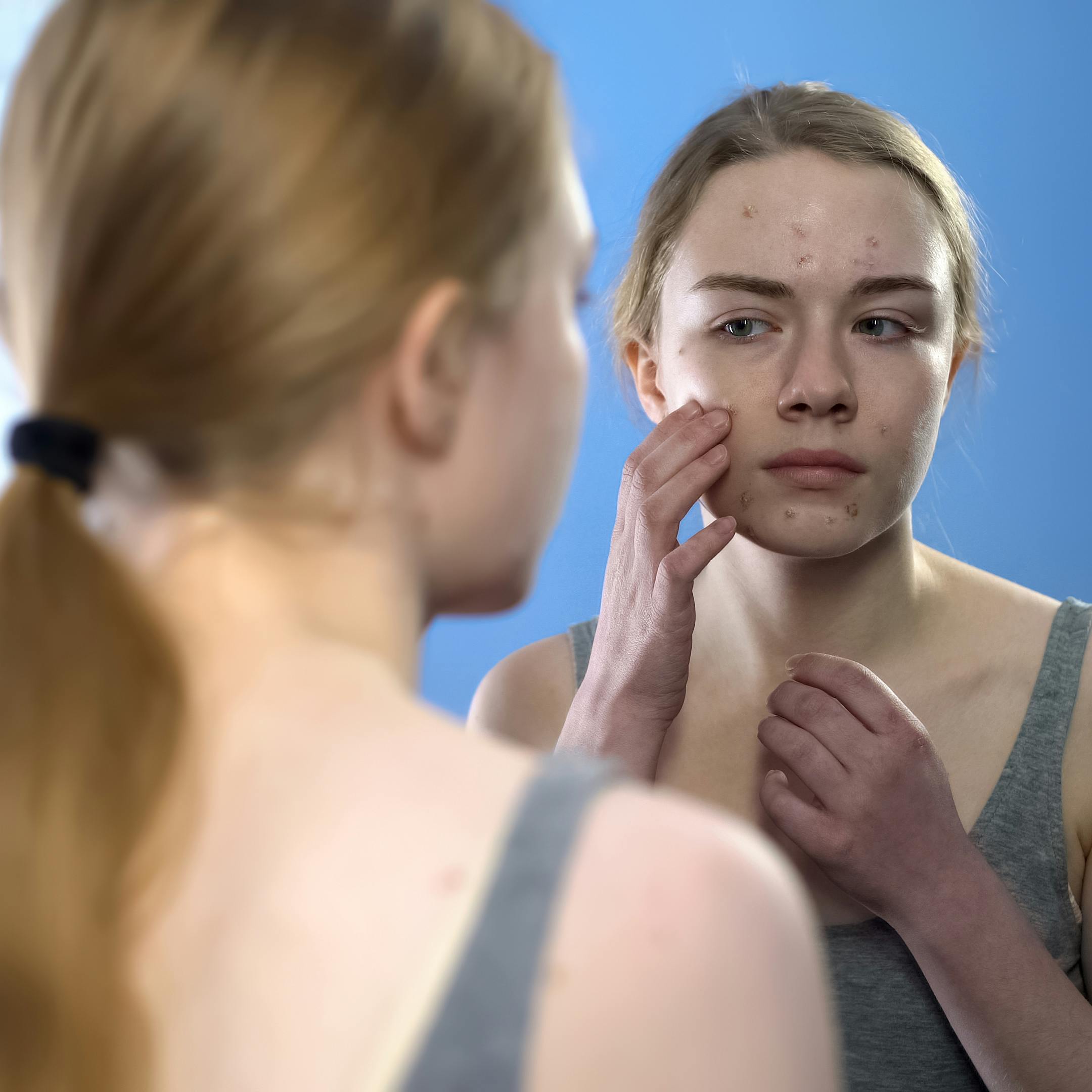 https://imgix.femina.dk/2023-04-21/voksen_akne_behandling.jpg