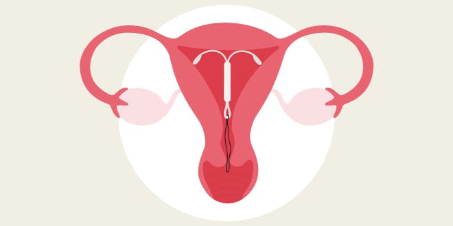 Illustration af livmoder med hormonspiral.
