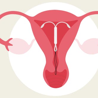 Illustration af livmoder med hormonspiral.