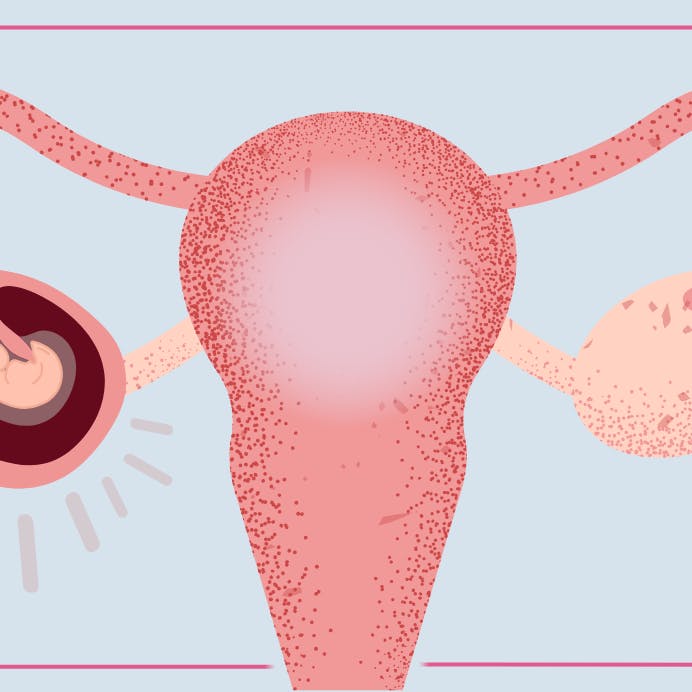 Illustration af en graviditet uden for livmoderen