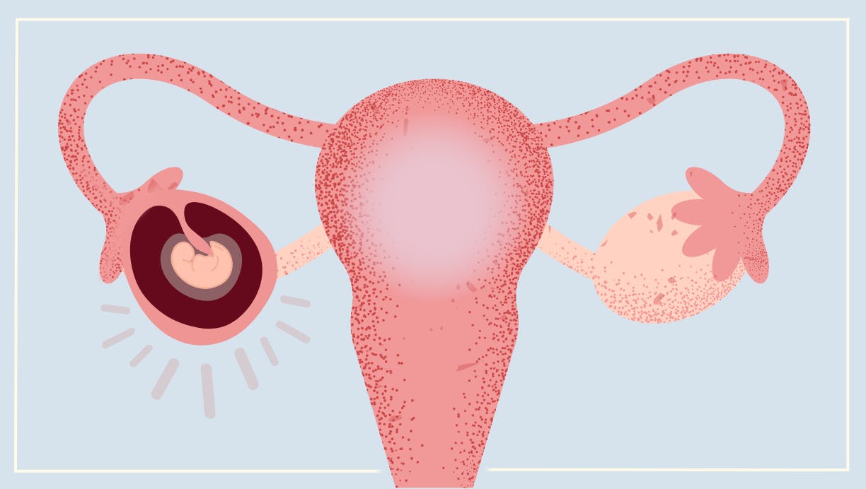 Illustration af en graviditet uden for livmoderen