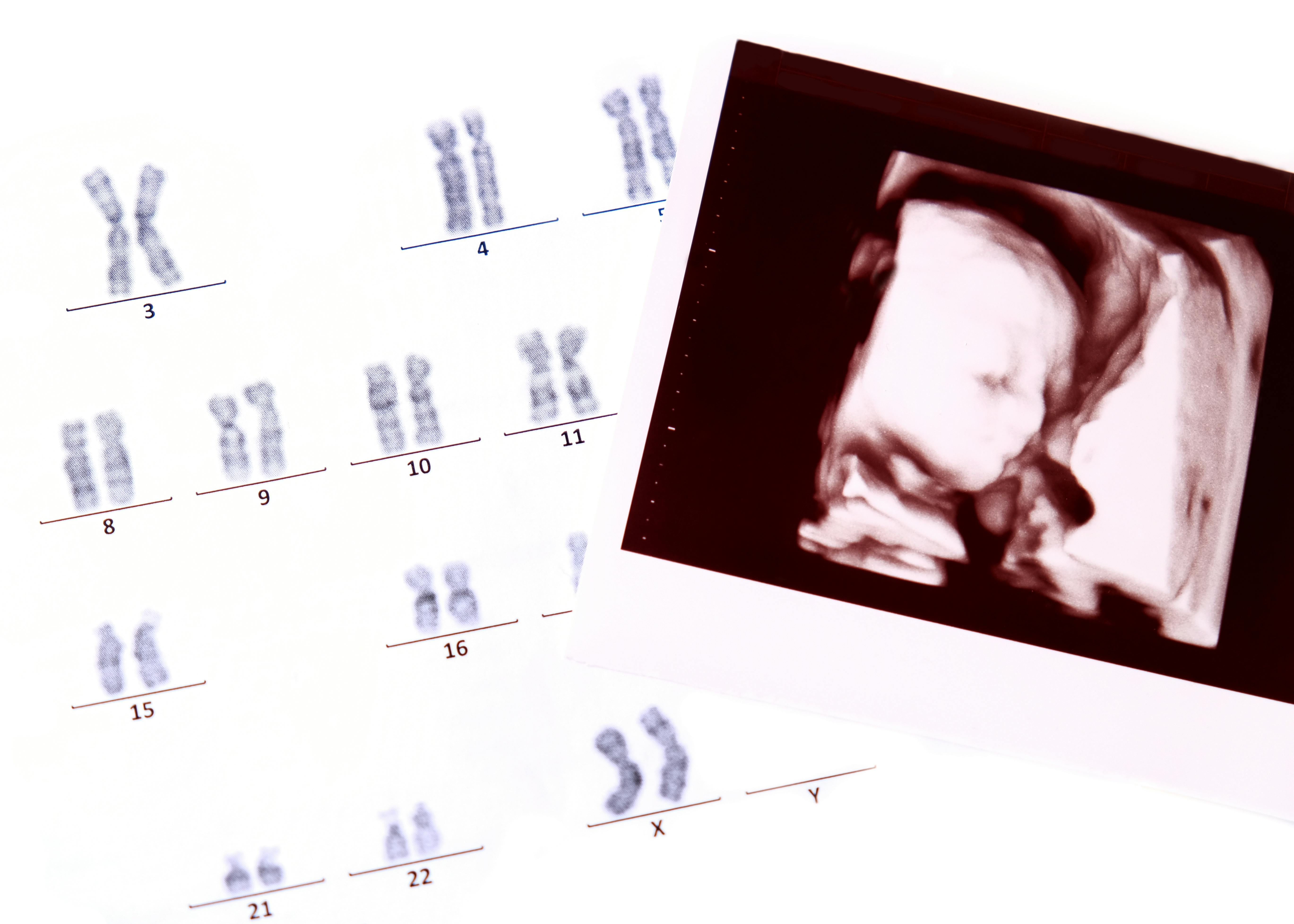 Nifty test, scan dit barn for kromosomafvigelser