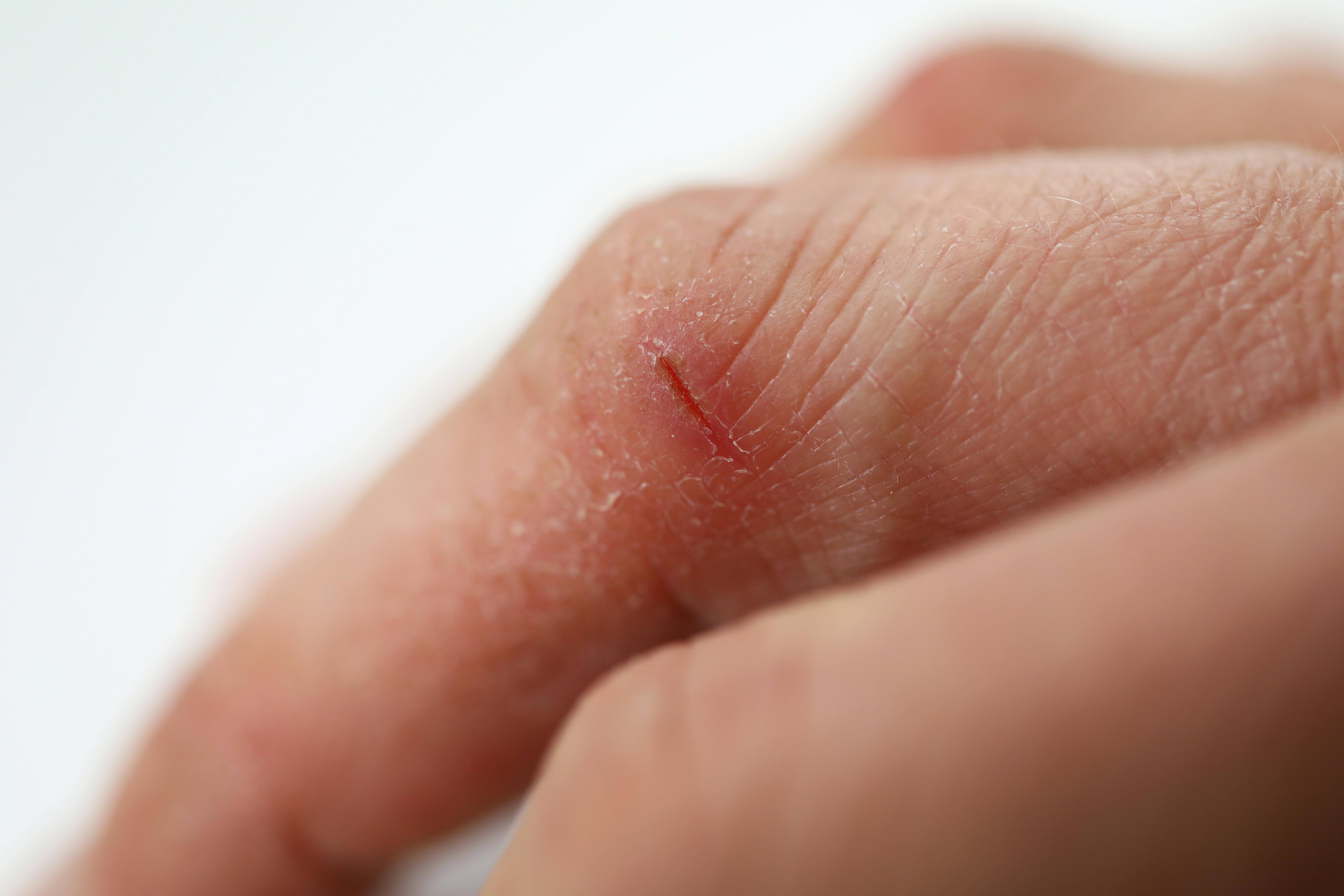 Close-up of person hand cutting. Dry fissured skin. Wounds and cracked on fingers. Skin disease. Slightly injured. Hands skincare. Dermatology and treatment concept