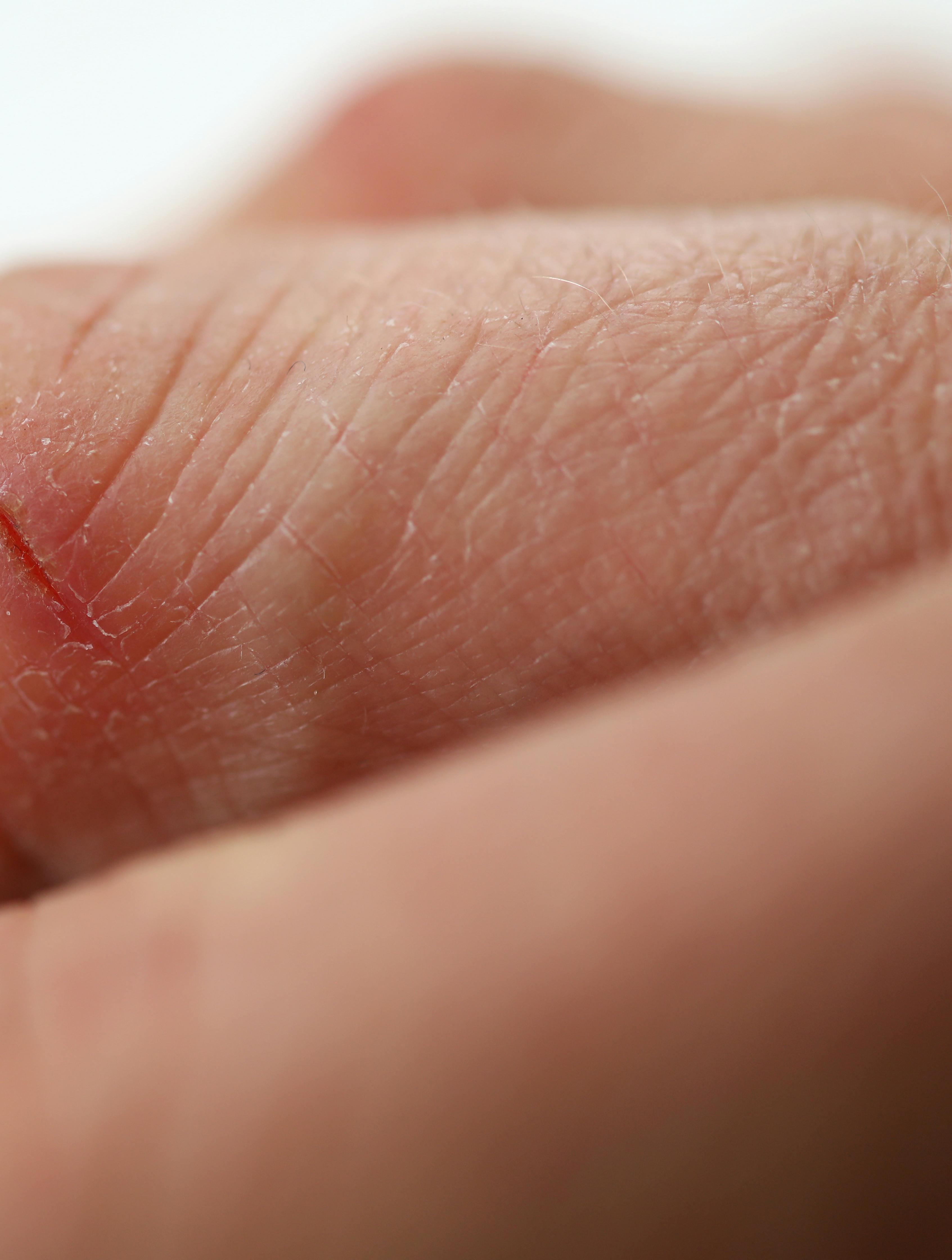 Close-up of person hand cutting. Dry fissured skin. Wounds and cracked on fingers. Skin disease. Slightly injured. Hands skincare. Dermatology and treatment concept