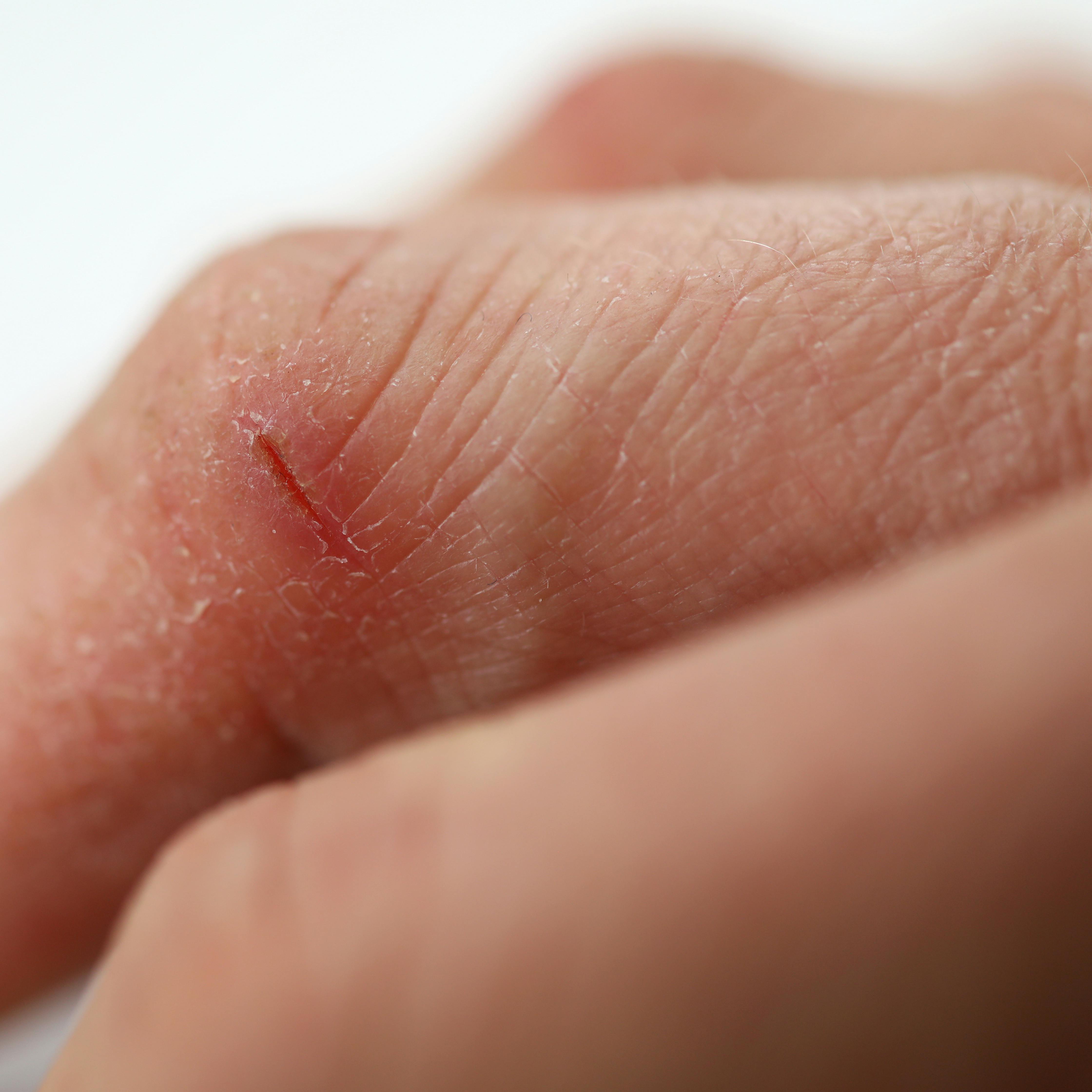 Close-up of person hand cutting. Dry fissured skin. Wounds and cracked on fingers. Skin disease. Slightly injured. Hands skincare. Dermatology and treatment concept