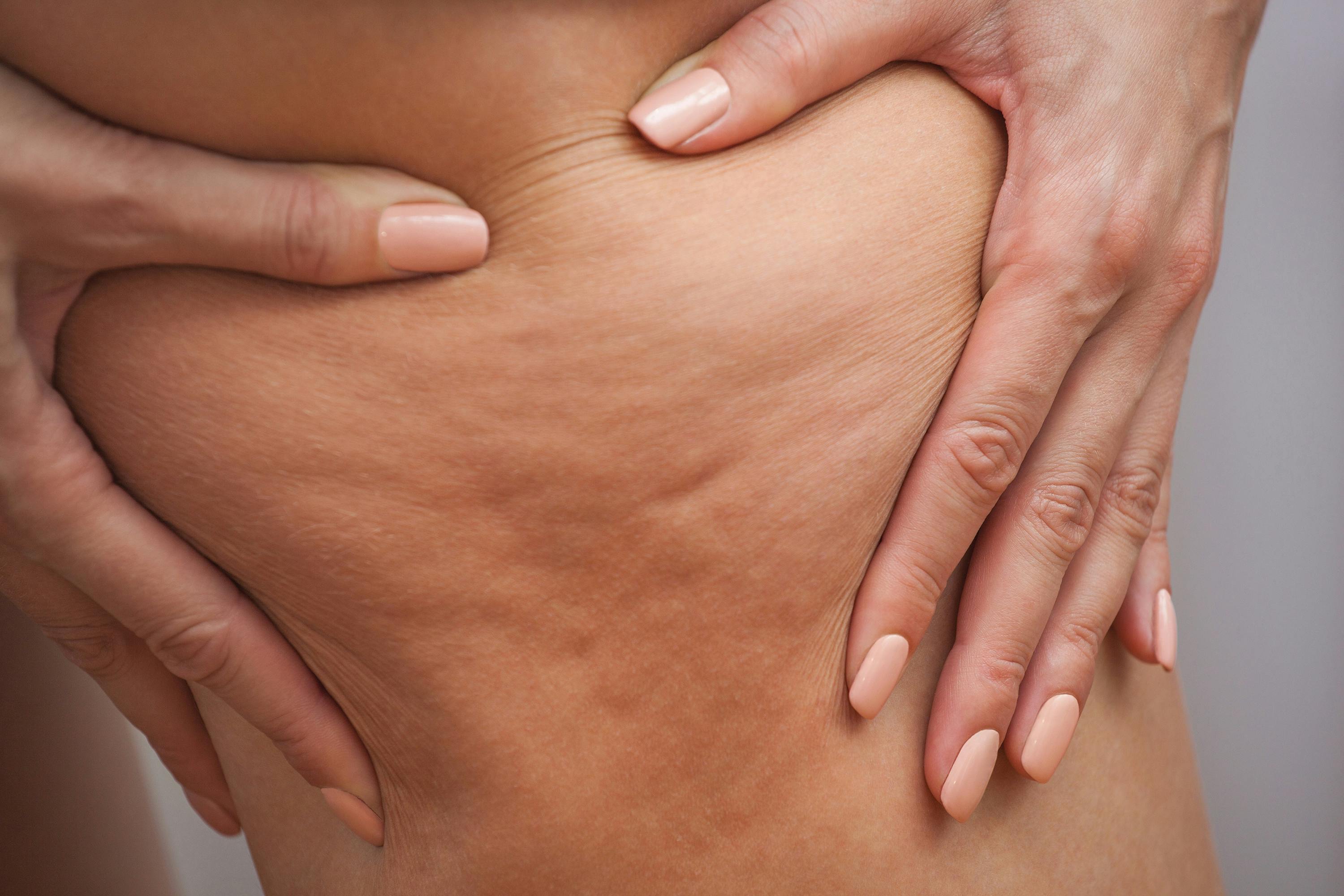 Girl shows holding and pushing the skin of the legs cellulite, orange peel. Treatment and disposal of excess weight, the deposition of subcutaneous fat tissue