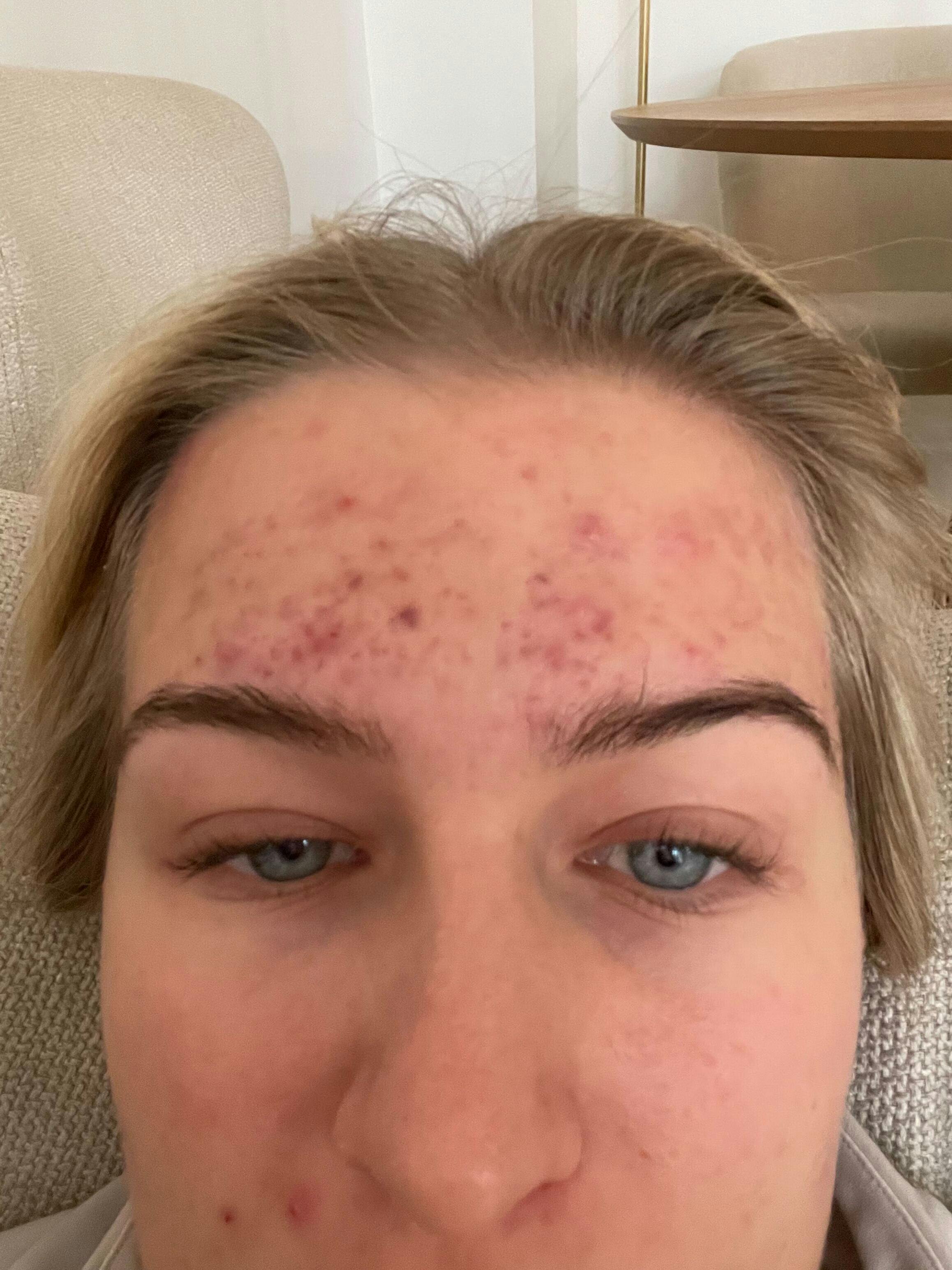 https://imgix.femina.dk/2025-09-18/acne.jpg