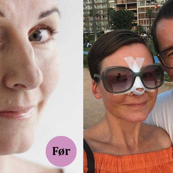 næseoperation før og efter